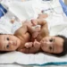 Siameses fueron separados con éxito tras casi un año en el hospital