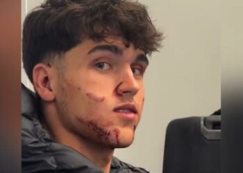 Así ha quedado la cara de Pau Cubarsí después de los 10 puntos de sutura