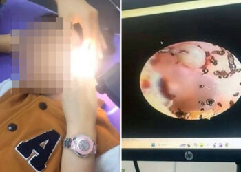 Una niña se queja de dolor de oído y los médicos encuentran cientos de garrapatas dentro