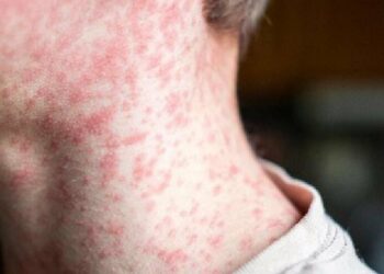 Sarampión en aumento en EE.UU.: brote en Texas registra más de 300 contagios