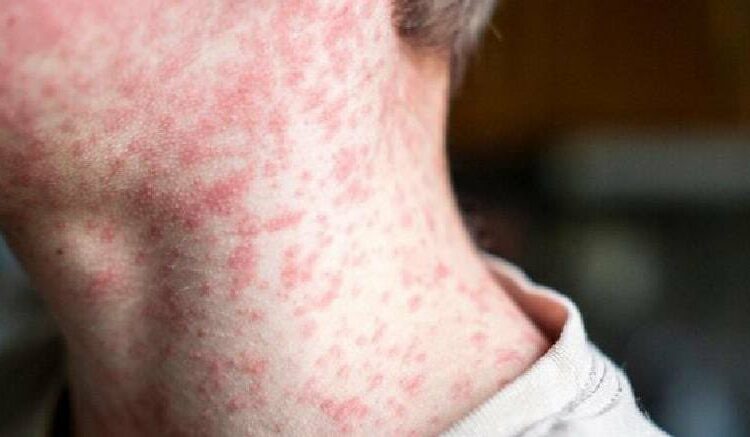 Sarampión en aumento en EE.UU.: brote en Texas registra más de 300 contagios