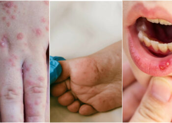 Instan a reforzar medidas sanitarias en hogares ante casos de enfermedad mano, pie y boca