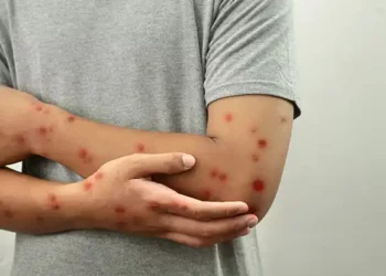 Confirman en Long Beach el primer caso de mpox clado I sin vínculo de viaje en EEUU