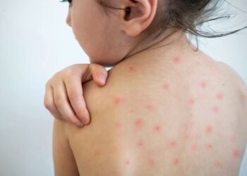 El Salvador acelera vacunación contra el sarampión y mantiene controlados los casos importados