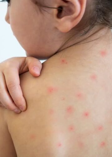 El Salvador acelera vacunación contra el sarampión y mantiene controlados los casos importados