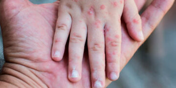 Ante alerta por sarampión, autoridades detallan síntomas para frenar más contagios