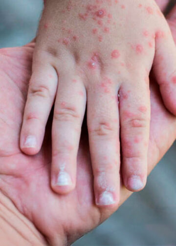 Ante alerta por sarampión, autoridades detallan síntomas para frenar más contagios