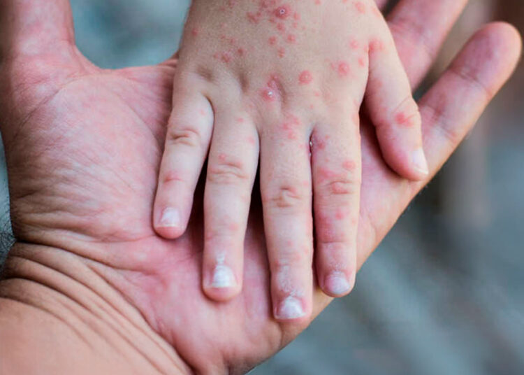 Ante alerta por sarampión, autoridades detallan síntomas para frenar más contagios