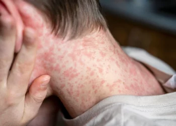 El Salvador mantiene alta cobertura de vacunación contra el sarampión y evita brotes según especialistas