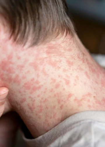 El Salvador mantiene alta cobertura de vacunación contra el sarampión y evita brotes según especialistas