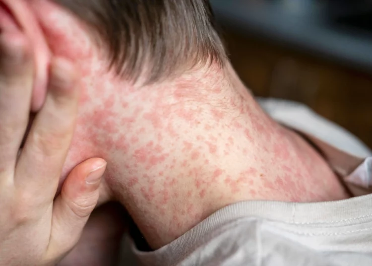 El Salvador mantiene alta cobertura de vacunación contra el sarampión y evita brotes según especialistas