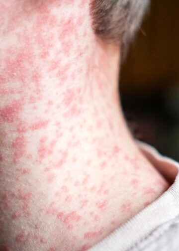 Salud activa vacunación nacional tras confirmarse casos de sarampión en el país